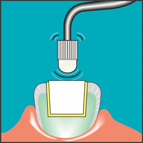 SONICflex CEM Tip #12 2003L/X